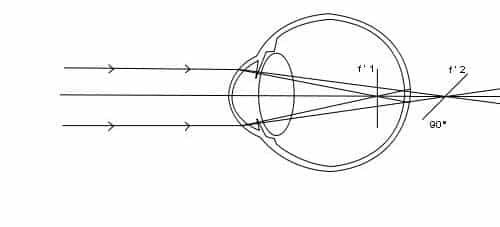 Schéma de rayons déviés par de l'astigmatisme