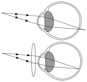 Schéma de l'hypermetropie et sa manière d'être corrigée avec un verre convexe