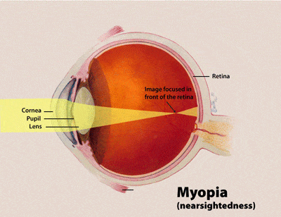 Coupe schématique de l'oeil représentant la myopie