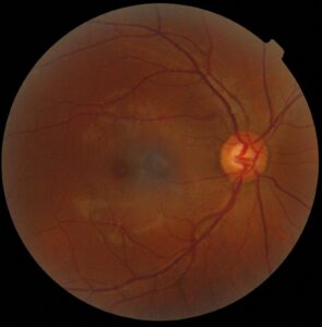 Rétinographie de l'œil : la macula est la tache sombre à gauche (la papille, origine du nerf optique, est la tache claire à droite).