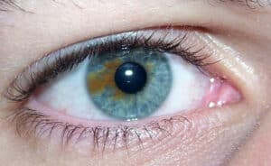 Hétérochromie partielle sur un iris (heterochromia iridium).