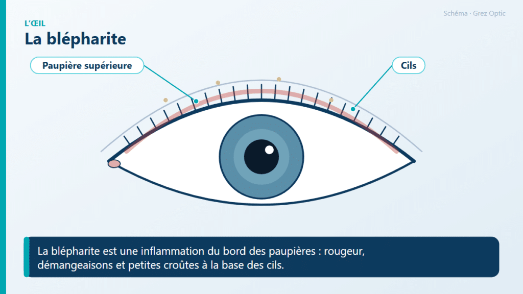 Schéma : La blépharite
