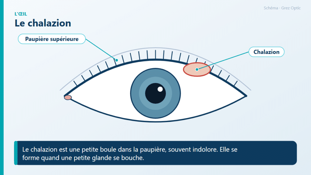 Schéma : Le chalazion