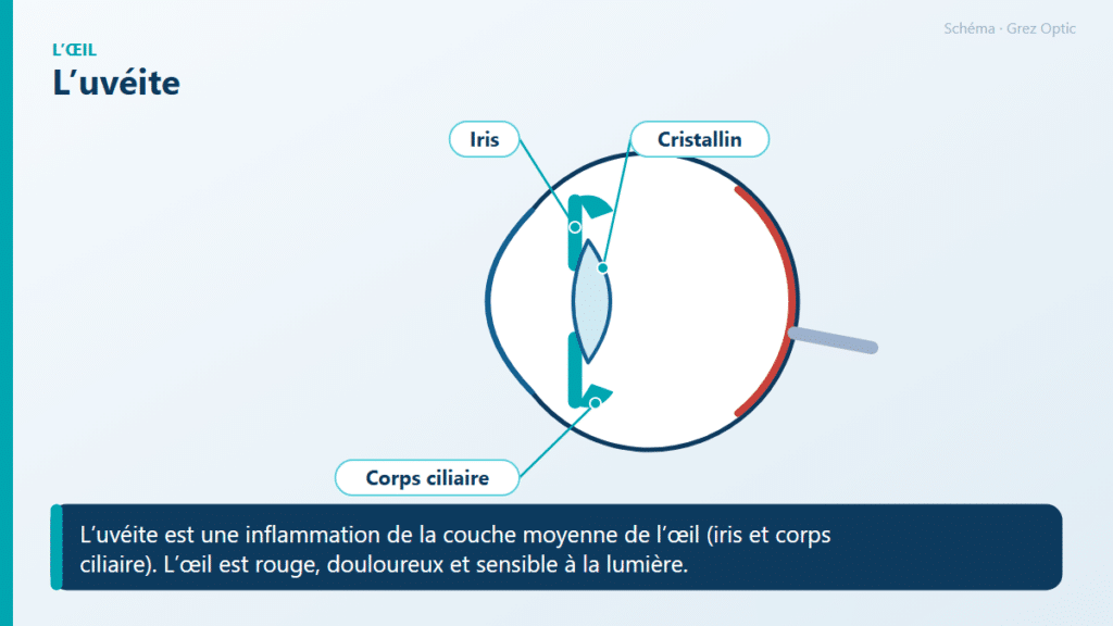 Schéma : L’uvéite