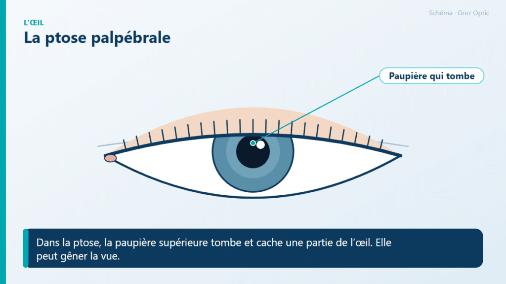Schéma : La ptose palpébrale