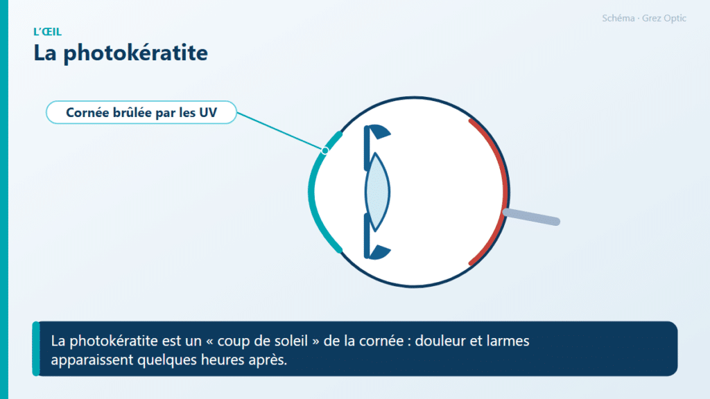 Schéma : La photokératite