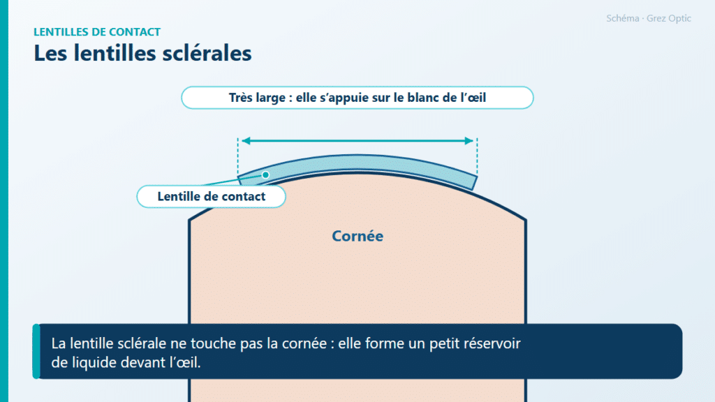 Schéma : Les lentilles sclérales