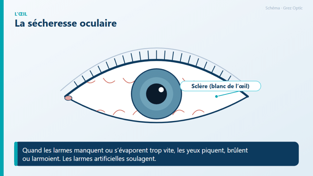 Schéma : La sécheresse oculaire