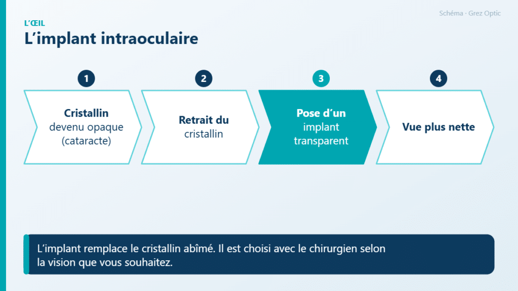 Schéma : L’implant intraoculaire